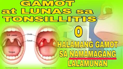 pamamaga ng tonsil|Gamot sa namamagang tonsil .